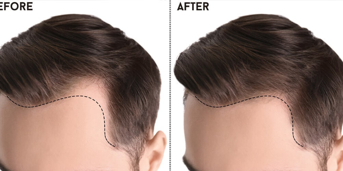 Comprehensive Guide to Hair Transplants in Islamabad