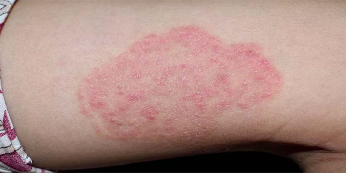 Fungal infections of the skin and soft tissue